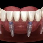 HAVE YOU LOST MANY TEETH ?