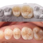 ZIRCONIA CAPPING