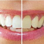 TEETH WHITENING