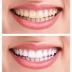 TEETH WHITENING