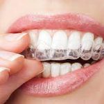 CLEAR ALIGNERS